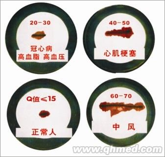 血栓檢測儀  MR-16加強(qiáng)型 血栓檢測儀